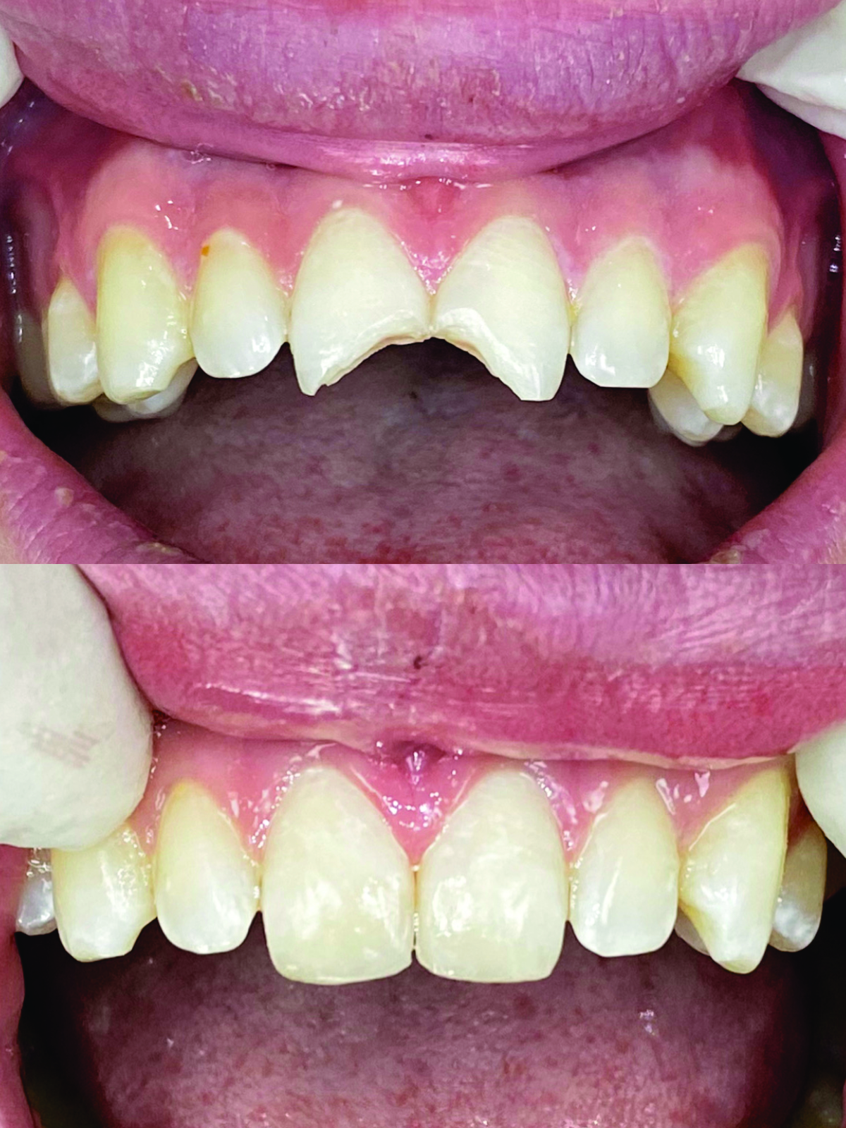 Before after Veneer Composite