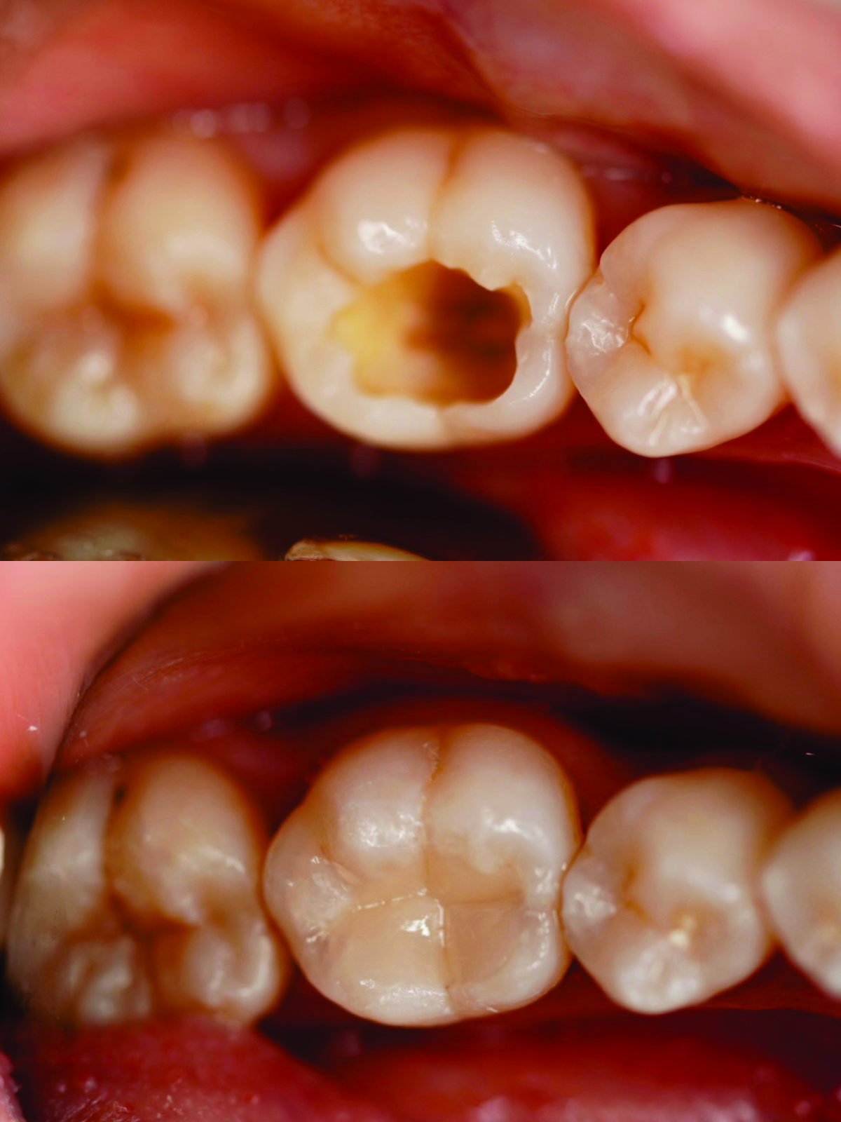 Before after Tambal Gigi